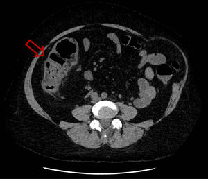 Non-injected abdominopelvic scan. Right ileocolitis, thickened appearance of the ascending colon with densification of pericolic fat.