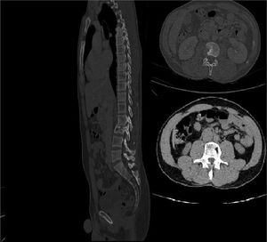 CT scan after the end of treatment showing no abscess and resolution of active osteomyelitis.