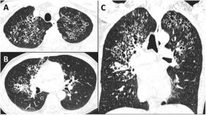Axial CT image at the apex (A) and at the level below the tracheal bifurcation (B). Coronal CT image of the lungs (C).