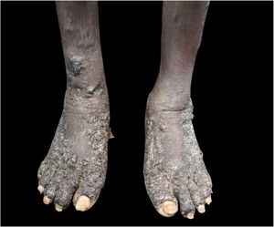 The Figure show hyperkeratotic plaques, forming a verrucous surface on the patient feet.