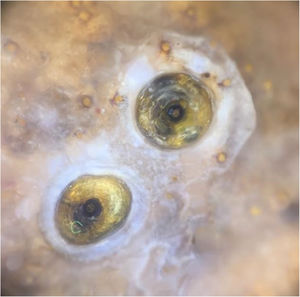 The Figure shows the Dermatoscopy magnified 10 times, displaying yellowish structures surrounded by a whitish halo and a brown central spot.