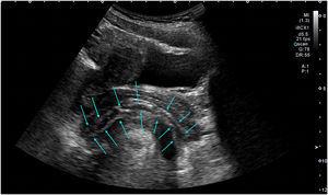 Longitudinal view of the rectum showing high echoic strand-like lesion (blue arrows). (For interpretation of the references to color in this figure legend, the reader is referred to the web version of this article.)
