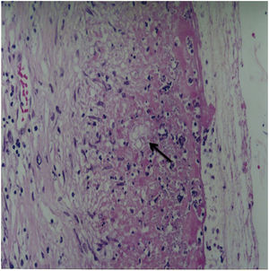 Histological section of the hepatic capsule shows rounded structures with birefringent cell wall, suggestive of the genus Paracoccidioides (black arrow) (H&E stain, 200× original magnification).