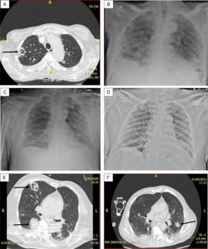(A) Case 1 – Thorax CT: Cavitary lesion (arrow) and numerous nodules in both lungs; (B) Case 1 – Thorax radiography: Diffuse consolidations, ground glass areas and nodules in both lungs. (C) Case 3 – Thorax radiography: Diffuse interstitial opacities and consolidations, some of that resembling nodules; (D) Case 5 – Thorax radiography: Bilateral and diffuse interstitial opacities containing micronodules and condensation in the lower lobe of left lung; (E) Case 6 – Thorax CT: Diffuse interstitial opacities, cavitary lesion with inner amorphous mass (large arrow), macronodule (thin arrow), and condensation in the right lung; (F) Case 7 – Thorax CT: ground glass opacities, macronodule (arrow) and peripheral consolidations in both lungs.