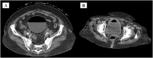 (A) Abdominal tomography showing gas inside the bladder and in its walls, (B) New abdominal tomography 14-days later evidencing significant improvement.