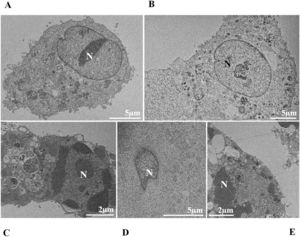 Nuclear alterations in Vero-E6 cells infected with SARS-CoV-2 variants. Control (uninfected) Vero-E6 cell [A], nuclei presenting changes in chromatin profile [B, C, E]), and pyknotic nuclei [D]). Uninfected Vero-E6 cell at 24 h of cultivation [A]. Vero-E6 cells infected with Alpha (48 hpi [B] and 72 hpi [E]), Gamma (72 hpi [C]) and Zeta (24 hpi [D]). Nucleus (N). TEM images.