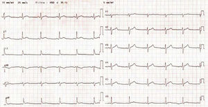 Electrocardiogram showing early repolarisation.