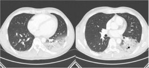 Chest computed tomography scan showed subpleural ground-glass opacities (black arrow) with a basal distribution in the left lower lobe and alveolar consolidations.