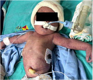 Petechial rash in a newborn with congenital chikungunya.