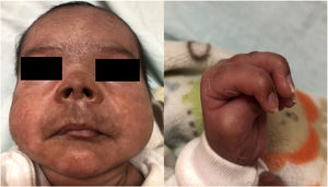 Hyperpigmented lesions on face and claw fingers.