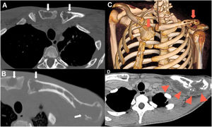 (A‒B) CT images obtained in the axial plane and bone window showing lytic lesion signs with cortical destruction of the left clavicle and manubrium and no periosteal reaction (white arrows). (C) Volume-rendered 3D image also demonstrating multiple osteolytic lesions with cortical rupture of the manubrium, sternum, and left clavicle (red arrows). (D) CT image obtained in the axial plane and soft-tissue window depicting fluid collection around the bony destruction of the left clavicle (red arrowheads).