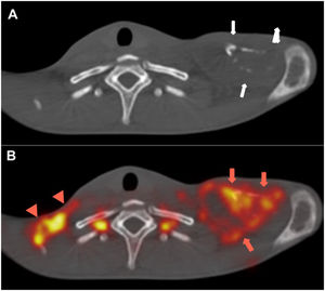 (A) Axial CT image (bone window) showing large erosions of the left clavicle with soft tissue swelling (white arrows). (B) Axial fused FDG PET/CT image showing FDG uptake (red arrows) of the lytic lesions in the left clavicle and in the fluid collection around the bone (SUVmax = 14.3). There is also intense uptake in the right supraclavicular lymph nodes (arrowheads).