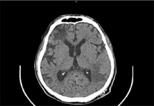 Brain computed axial tomography imaging of the patient that shows left frontal subcortical hypodensity, a left temporo-parietal hypodense lesion.