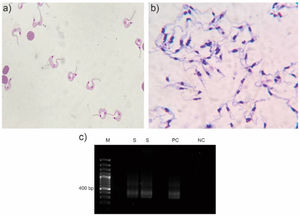 Diagnosis of Trypanosoma cruzi: (a) Giemsa stain of the CSF sample that revealed the presence of trypomastigotes; (b) Giemsa stain of epimastigotes after the culture procedures applied; (c) PCR that confirms the diagnosis of T. cruzi. M, Gene ruler 100 bp DNA ladder (Thermo Fisher, USA); S, sample; PC, positive control (DNA from T. cruzi TCR4); NC, negative control.