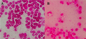 (A) Gram staining performed on the Blood cultures detected Gram-negative rods (1000 × magnification). (B) Gram staining performed on the drainage fluid detected Gram-negative rods (1000 × magnification).