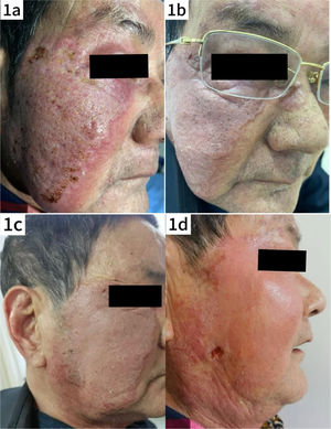Clinical evolution of the patient's skin lesions. (a) Photograph taken at the patient's initial visit shows red plaques with mild infiltration, well-defined borders, scaling and elevated local skin temperature. (b) Photograph taken before discharge after inpatient treatment, showing significant reduction in facial swelling. (c and d) Photographs taken during follow-up after the patient's self-treatment, showing new areas of mild erosion and worsening of the lesions compared to the previous condition.