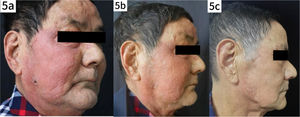 (a) Photograph taken after adjustment of treatment regimen following confirmed diagnosis of protothecosis. (b) Photograph showing improvement one week after discharge. (c) Follow-up photograph after five months of treatment, documenting complete resolution of lesions.