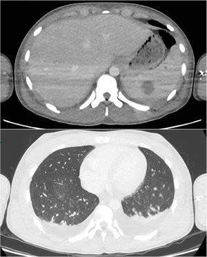 Hepatosplenic and pleuropulmonary lesions. CT scan performed at Day 10. Adenomegalia of the celiac region and hepatic hilum. Hepatomegaly with one lesion of the left liver. Multiple splenic lesions.