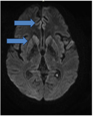 The brain MRI diffusion sequence images show a symmetric and bilateral hypersignal in the caudate and putamen, as well as in the superior frontal gyri (blue arrow).