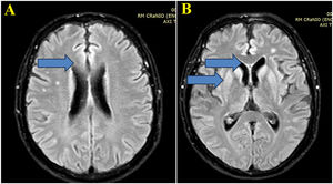 (A) Brain MRI images with Axial FLAIR sequence at the centrum semiovale show a small cortical hypersignal in the superior frontal gyrus bilaterally (blue arrow). (B) Brain MRI images at the basal ganglia level also demonstrate a symmetric and bilateral hypersignal in the caudate and putamen, as well as in the superior frontal gyri (blue arrow).