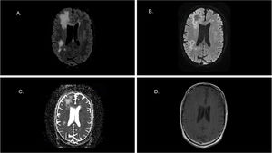 (A) 3D-FLAIR image shows areas of hyperintense signal in the white matter of the right hemisphere involving the U fibers. (B) DWI and respective ADC map (C) show that lesions manifest a hypersignal wavefront spreading without diffusion restriction (lack of hyposignal in ADC map). This finding indicates an activee myelinoclastic process at the wavefront. (D) The axial T1 image after contrast medium administration shows no enhancement of the lesions.