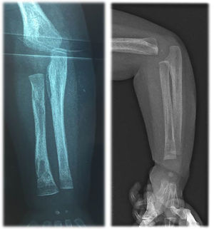 Lower part of radius periostitis and osteomyelitis before antibiotics (a) and after one month after antibiotics treatment (b).
