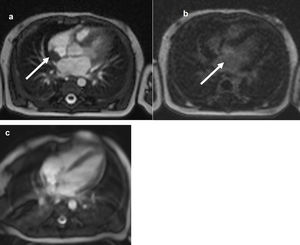 Cardiac-MRI comparison of intracardial mass (arrow) between the diagnosis and (a‒b) 20-months follow-up (c). T2 TrueFISP Sequence: Right intra-auricular mass at T2, attached to the posterior surface of the atrium and to the posterior part of the inter-atrial septum. Sequence after gadolinium injection: No lesion enhancement. Complete regression of intra-atrial mass.