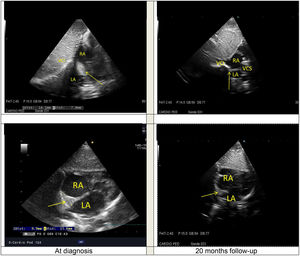 Echocardiographic views comparison of intracardial mass (yellow arrow) between the diagnosis and 20-months follow-up. RA, Right Atrium; LA, Left Atrium; IVC, Inferior Vena Cava; SVC, Superior Vena Cava.