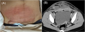 (A) Abdominal findings: the erythema, warmth, and tenderness noted in a band around the head of the wound in the lower abdomen and pus discharge from the right end of the wound. (B) Contrast-enhanced computed tomography scan revealing a fluid collection with foamy gas formation extending from both rectus abdominis muscles to the subcutaneous tissue. The lesion was encapsulated by an enhancing rim and surrounded by fat strands, suggestive of abscess formation.