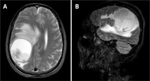 Axial T2-weighted MRI (A) shows a lesion measuring 5.9 × 5.4 × 5.4 cm (CC × LL × AP) and exerts a compressive effect on the brain parenchyma, with hyperintense areas in the white matter secondary to vasogenic edema, accompanied by subfalcine herniation and right uncal herniation into the suprasellar cistern. There is an approximate 1.7 cm midline shift to the left. Peripheral rim enhancement without surrounding capsule irregularity is observed, findings that are suggestive of a tuberculous abscess rather than a pyogenic one. Sagittal MRI on T1 complements the visualization of the lesion (B).