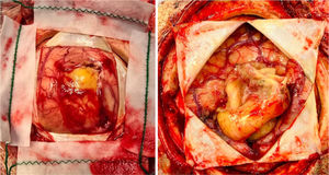 Photo from the surgery showing an encapsulated lesion, well-demarcated from the brain, with an abscess-like appearance.