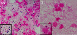 (A) Gram staining of the wound swab revealing White Blood Cell (WBC) 3+, Gram-Positive Cocci (GPC) 3+, and gram-negative cocci 3+. (B) Gram staining of the subcutaneous abscess showing WBC 3+ and GPC+.