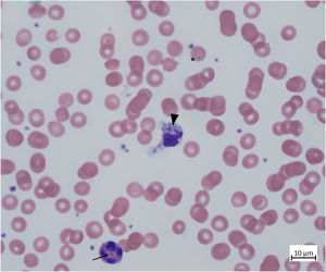 Peripheral blood smear of a 4-month-old girl (black arrow probably indicating the inactivated X-chromosome [“Barr body”]) with meningococcal sepsis. The exceedingly rare findings of intraleukocytic cocci and diplococci (black arrowhead) and peri-/intraerythrocytic diplococci (black asterisk) are depicted. Microbiological PCR-diagnostics confirmed invasive infection with Neisseria meningitidis serogroup W.