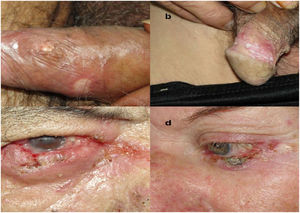 (A) Ulcerated lesions on the prepuce; (B) Vegetative, whitish lesions with an erythematous halo in the balanopreputial sulcus; (C) Eyelid involvement of paracoccidioidomycosis with an extensive lesion on the lower eyelid, presenting a granulomatous, infiltrative, and hemorrhagic aspect, with conjunctival involvement; and (D) Crusted lesion on the lower eyelid. All patients were treated at the Reference Center.