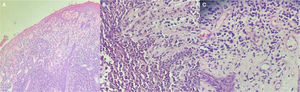 (A) Pseudoepitheliomatous hyperplasia with ulceration (H&E, ×10). (B) Neutrophilic collections within the dermal inflammatory infiltrate (H&E, ×400). (C) Dense plasma cell-rich inflammatory infiltrate (H&E, ×400).