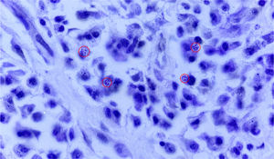 Periodic Acid-Schiff (PAS) stain demonstrating intracytoplasmic Donovan bodies (red circles) within macrophages, confirming the diagnosis of granuloma inguinale (original magnification ×1000, oil immersion).