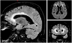 Brain magnetic resonance imaging demonstrating periventricular and pachymeningeal enhancement, suggestive of periventricular leukoencephalopathy.