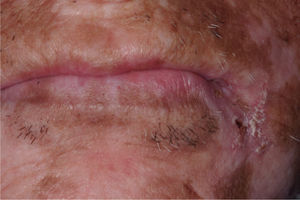 Diffuse hypochromic and hyperchromic skin lesions characteristic of chronic cutaneous graft-versus-host disease.