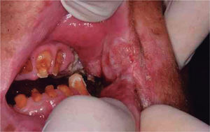 Indurate and asymptomatic retrocomissural lesion. Poor oral hygiene was evident with multiple acute carious lesions, the accumulation of gross biofilm, gingivitis and restricted mouth opening.