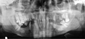 Panoramic radiograph showing the poor dental status.