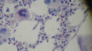 Bone marrow with dysmegakaryopoiesis and dyserythropoiesis. Hematoxylin and eosin stain, original magnification 400×.