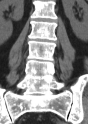 Computed tomography scan of the lumbar spine and sacrum – scattered osteosclerotic lesions on vertebrae, sacrum and iliac bones (coronal view).