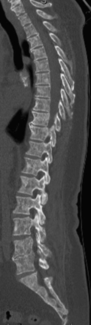 Computed tomography scan of the lumbar spine and sacrum – osteosclerotic and osteolytic lesions, without expansive features, spread throughout the axial skeleton (sagittal view).