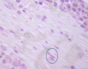 Hematoxylin-eosin stain (magnification: 400×) – peripheral fibrosis and atypical mast cells with fusiform shape (circle).