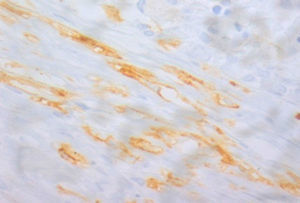 Positive staining for CD117 (magnification: 400×) identifying atypical mast cells with fusiform shape.