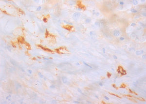 Positive staining for tryptase of mast cells (magnification: 400×). CD117 is not specific so this analysis is essential to definitive diagnosis.