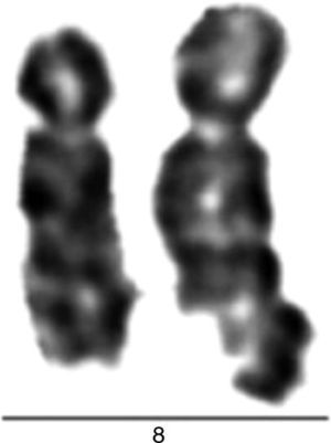 Case 20; bone marrow. Partial karyogram showing chromatid breaks in the long arm of chromosome 8.