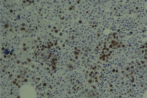 Strong staining (40%) of the p53 protein in bone marrow (streptavidin–biotin – magnification: 400×).