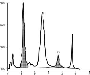 High performance liquid chromatography chromatogram (beta thalassemia short program) when the child was 45 days old. The original line of the chromatogram was traced over to make it clearer 4 years after printing on a thermo-sensitive paper. The relative concentration of Hb A is already higher than that of Hb F, as expected. The estimated relative concentration of Hb M Iwate (area under the peak at the retention time of 4.74min) is 8.8% [image kindly sent by the Blood Center of Ribeirão Preto, São Paulo, Brazil].