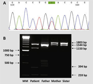 Genotyping study of the mutation that results in hemoglobin M Iwate. (A) Electrophoregram corresponding to the sequencing of exon 2 of the alpha2-globin gene of the proband, showing the heterozygous mutation CAC>TAC at codon 87 (His>Tyr); (B) Electrophoresis of DNA in 1% agarose gel stained with ethidium bromide showing PCR product after restriction digestion with the enzyme RsaI. The largest fragment with 1803bp does not contain any restriction site for RsaI and corresponds to the amplification of HBA2 without the M Iwate mutation and with the C-polymorphism at site rs2541669 (NG_000006.1:g.33004C>T); the fragments with 1544 pb and 269bp result from the rs2541669 T-polymorphism and HBA2 without M Iwate mutation; fragments with 1150 and 394 result from the action of RsaI on the new restriction site created by the M Iwate mutation. Specific amplification of HBA2 was performed with alpha2/3.7-F and alpha2-R primers.3 MM=250bp molecular marker; bp=base pairs.